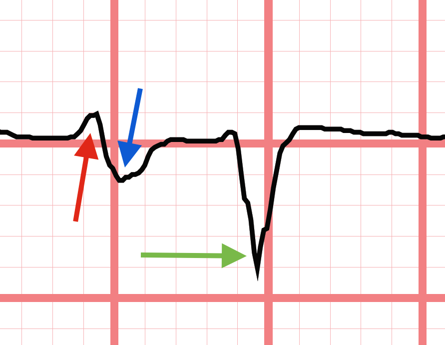 Lae Produces A Biphasic P Wave In V 1 4479